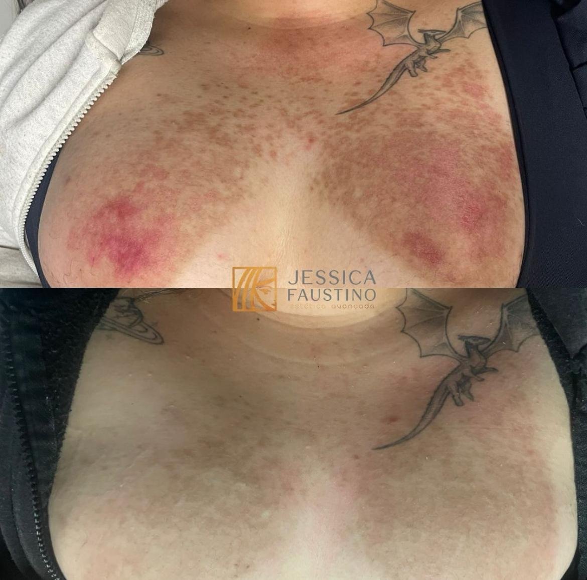 Antes e Depois Laser Lavieen - Resultados visíveis
