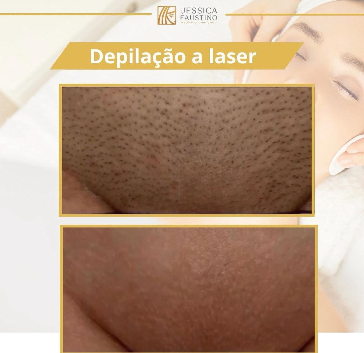 Antes e Depois Depilação a Laser - Resultados visíveis
