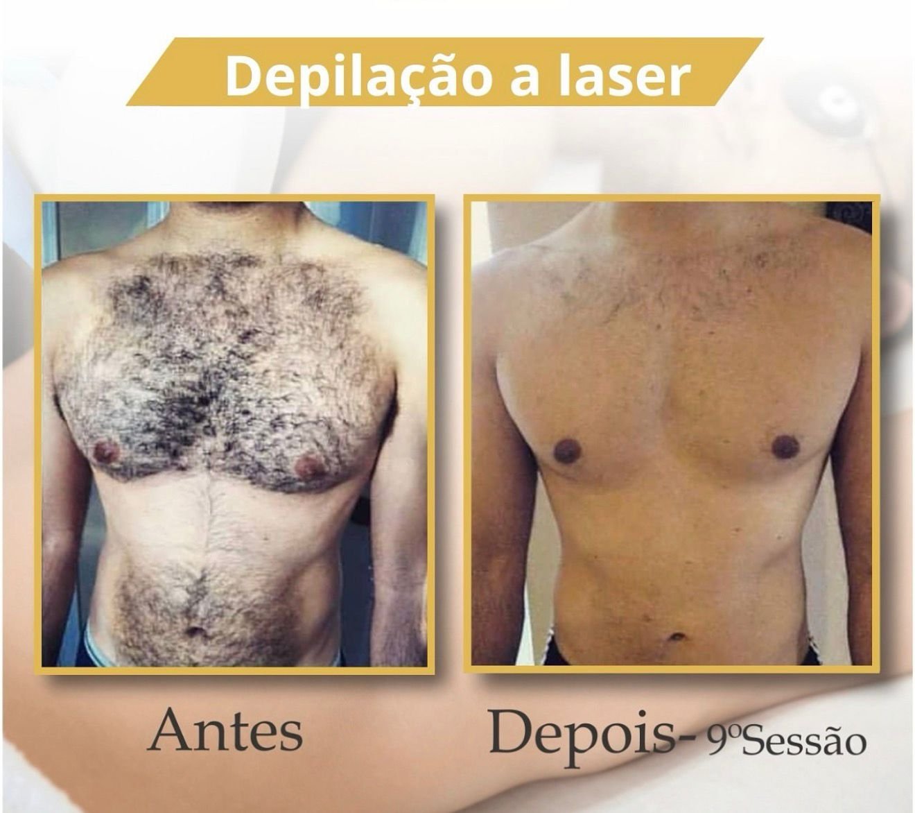 Antes e Depois Depilação a Laser - Caso 2