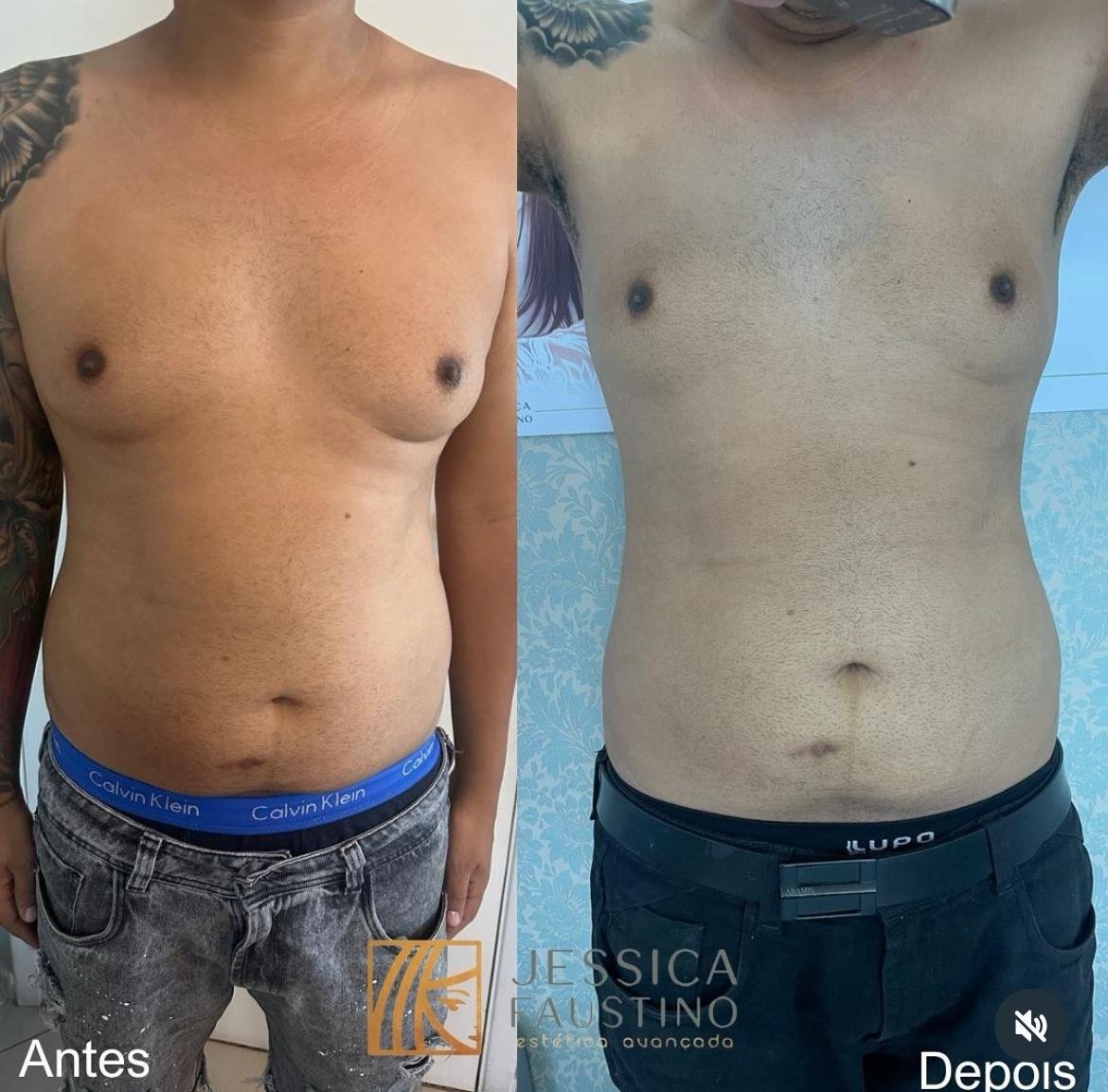 Antes e Depois Enzimas - Resultados visíveis