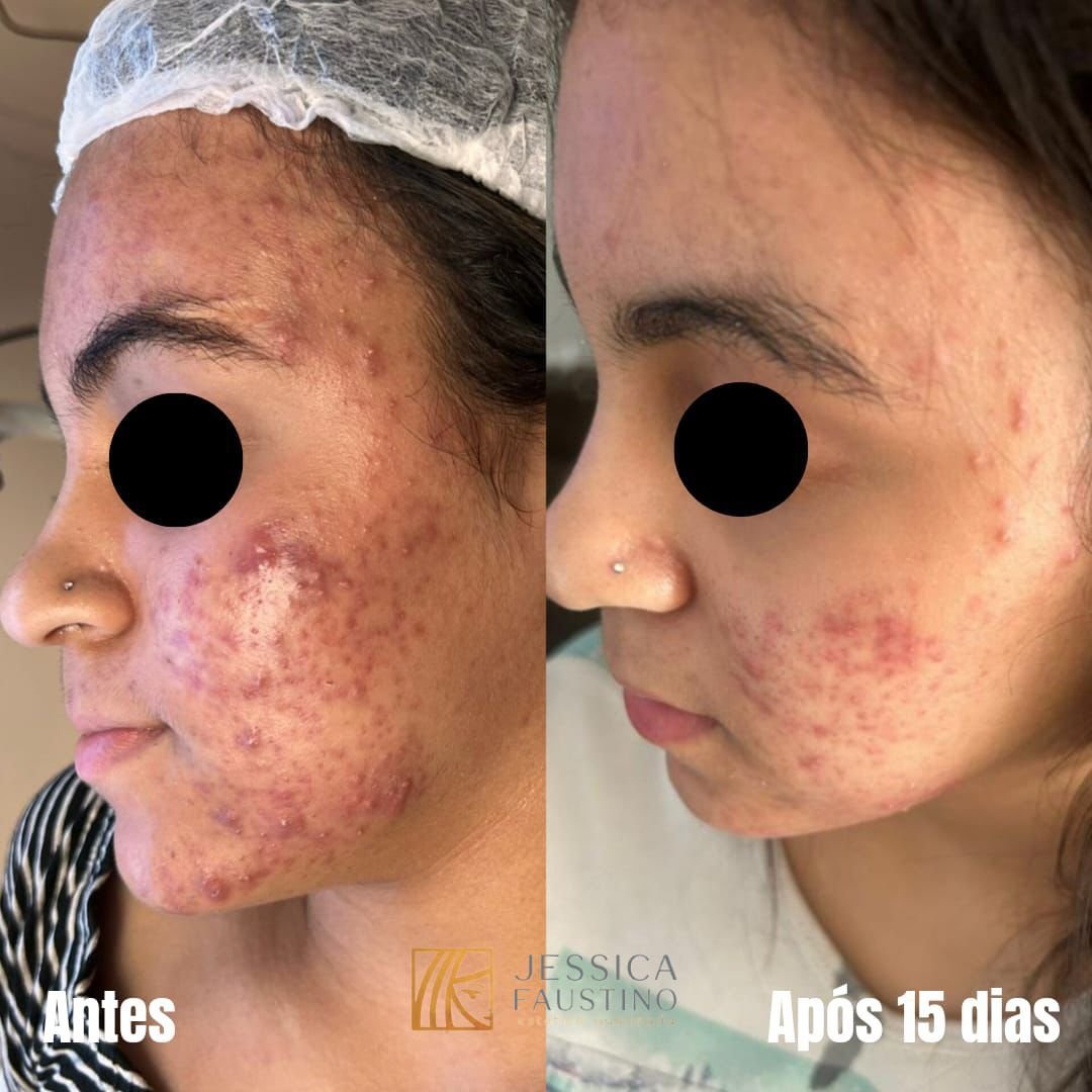 Antes e Depois Laser Harmony - Caso 2