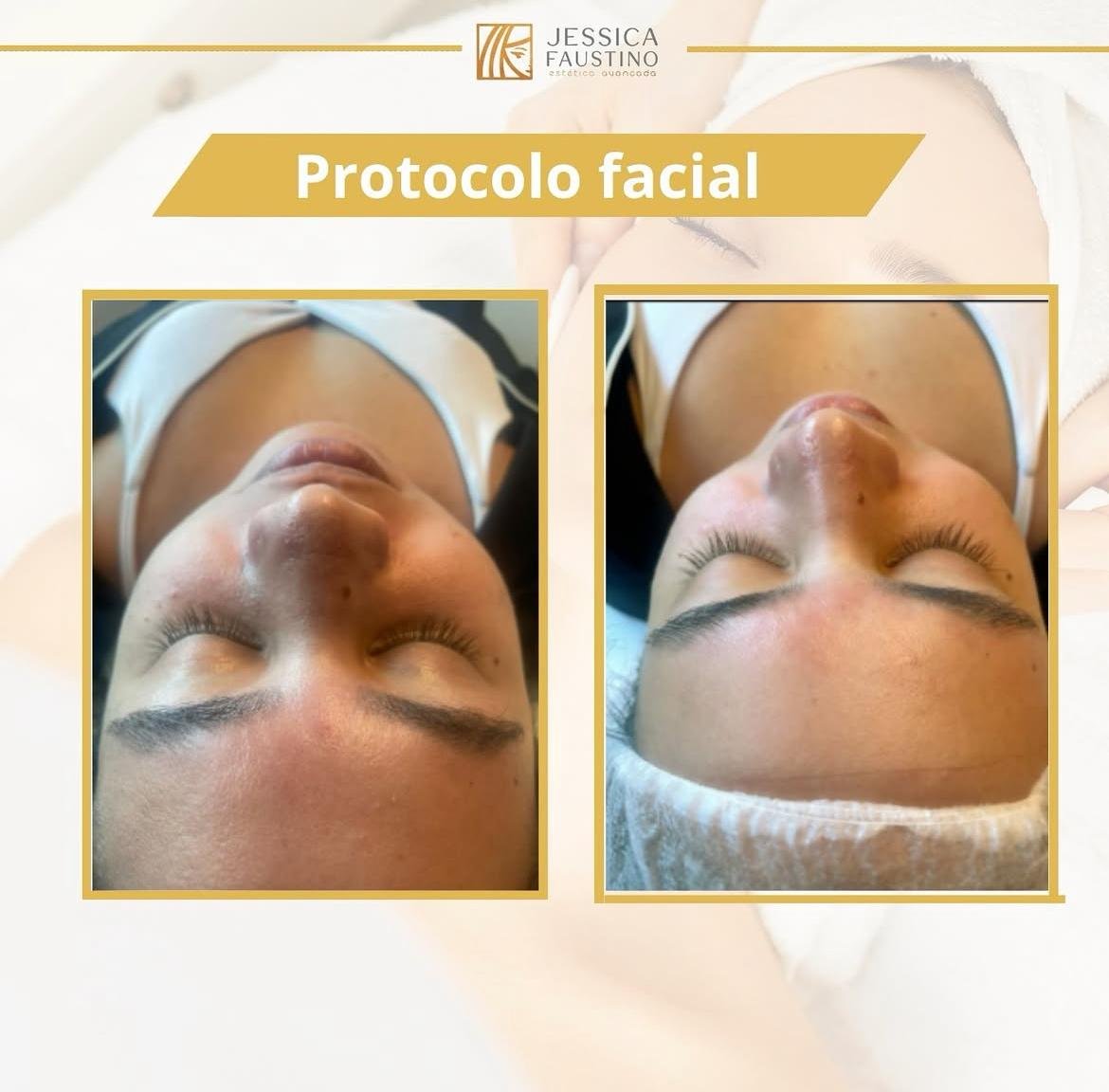 Antes e Depois Limpeza de Pele - Resultados visíveis