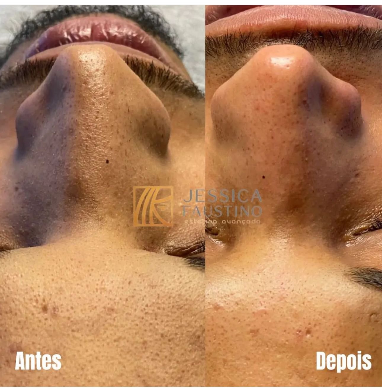 Antes e Depois Limpeza de Pele - Caso 2