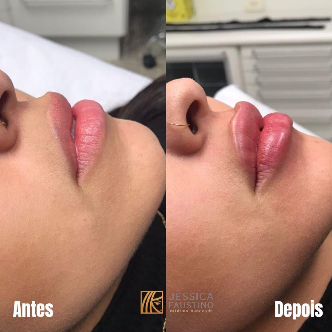 Antes e Depois Preenchimento Labial - Caso 1
