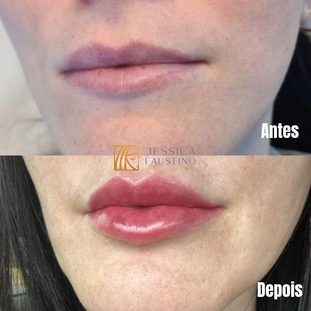 Antes e Depois Preenchimento Labial - Caso 2
