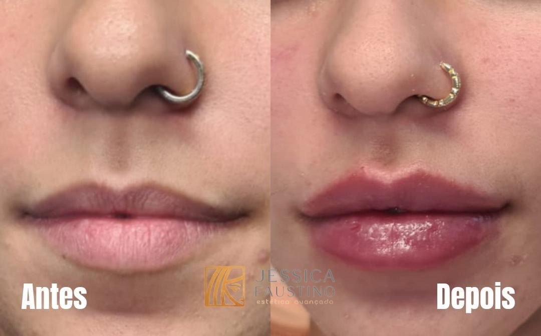 Antes e Depois Preenchimento Labial - Caso 3