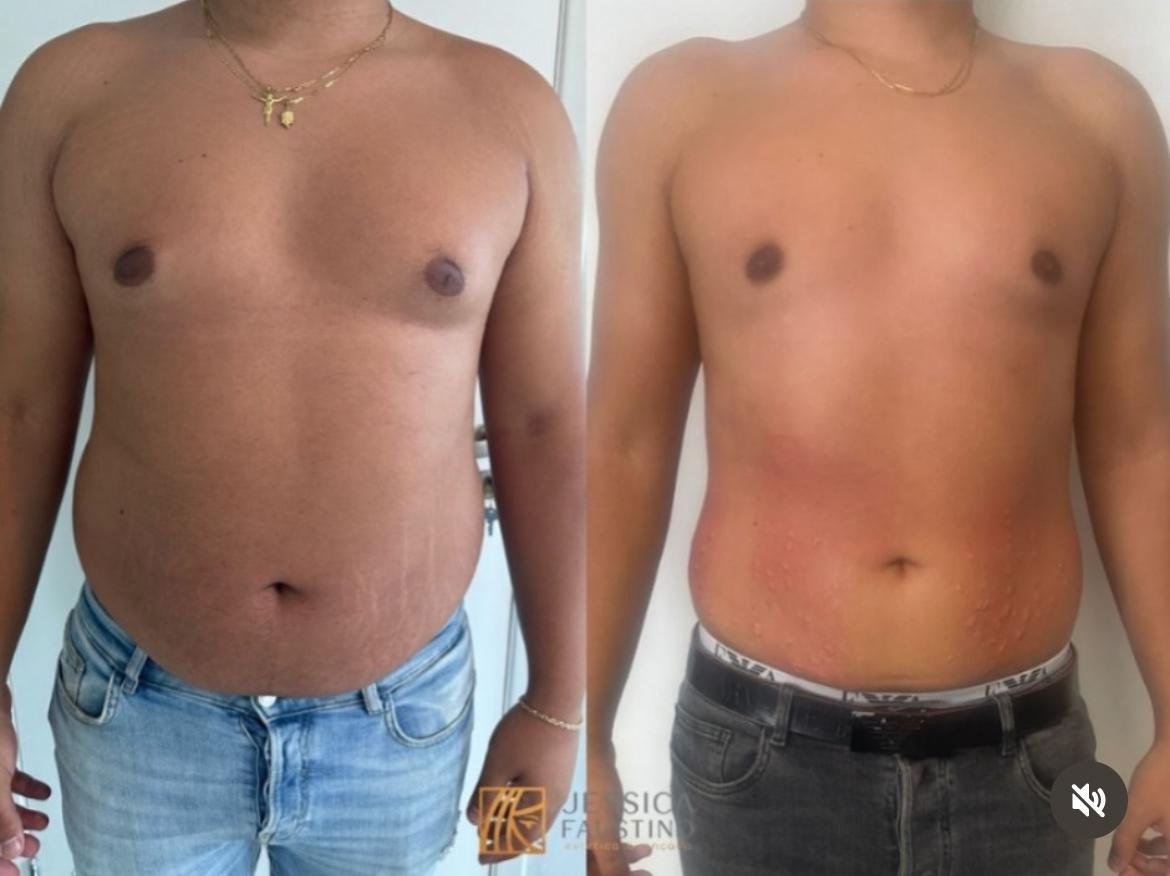 Antes e Depois Tirzepatida - Resultados visíveis