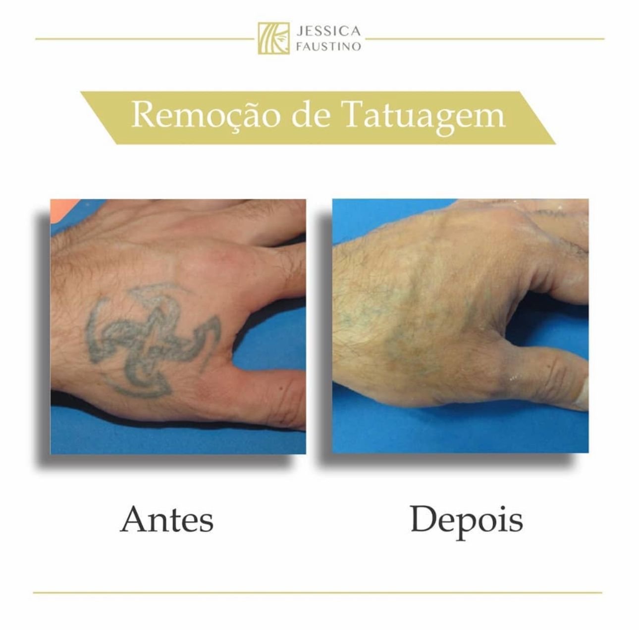 Antes e Depois Remoção de Tatuagem - Caso 2